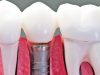 Dantų implantai Šiauliuose: kaip rasti palankiausią galimybę?