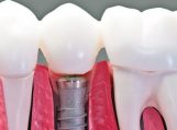 Dantų implantai Šiauliuose: kaip rasti palankiausią galimybę?