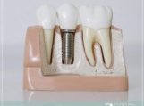 Dantų implantų tipai